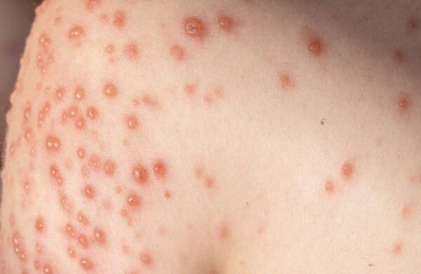 Salud mantiene protocolos activos tras nuevo contagio de viruela del mono