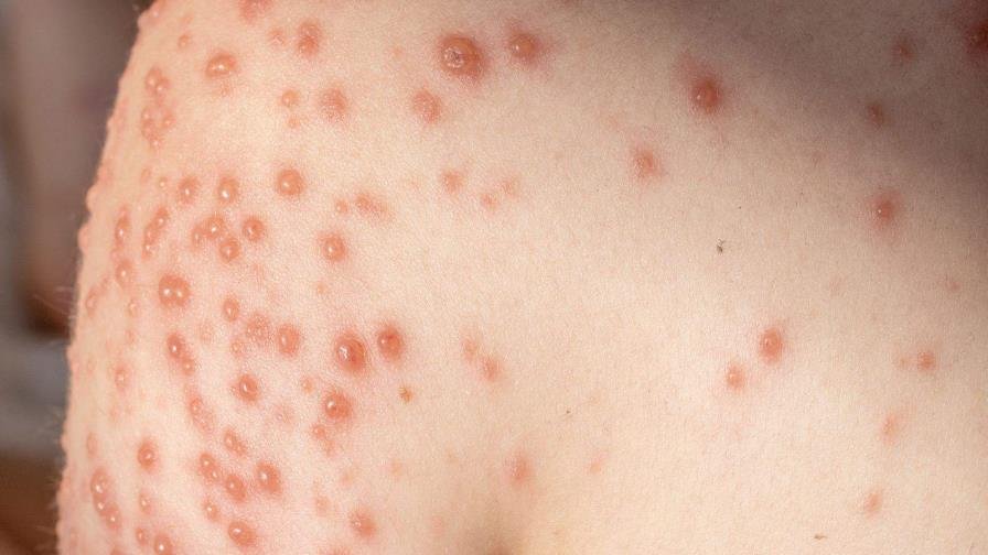 Salud mantiene protocolos activos tras nuevo contagio de viruela del mono